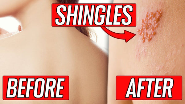 The Stages, Signs & Symptoms of Shingles